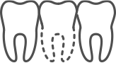 line drawing of a jaw line in need of bone grafting